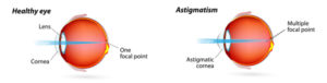 Astigmatism Correction