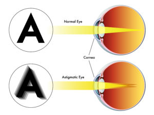 Astigmatism Correction