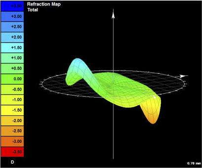 Dioptric power map of unaided eye shows refractive error of several diopters across the pupil