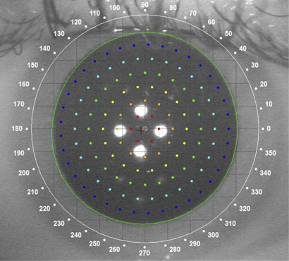 pupil of patient – 256 sequential laser beams