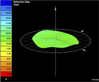 wavefront-guided optics results in perfectly flat dioptric power map and perfect 20/10 vision