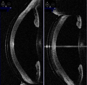 OD_90 DECENTERED + CENTERED