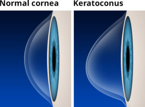 keratoconus treatment