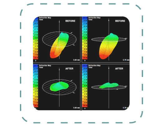 OCT mapping of eye anterior for Custom Scleral Lens creation